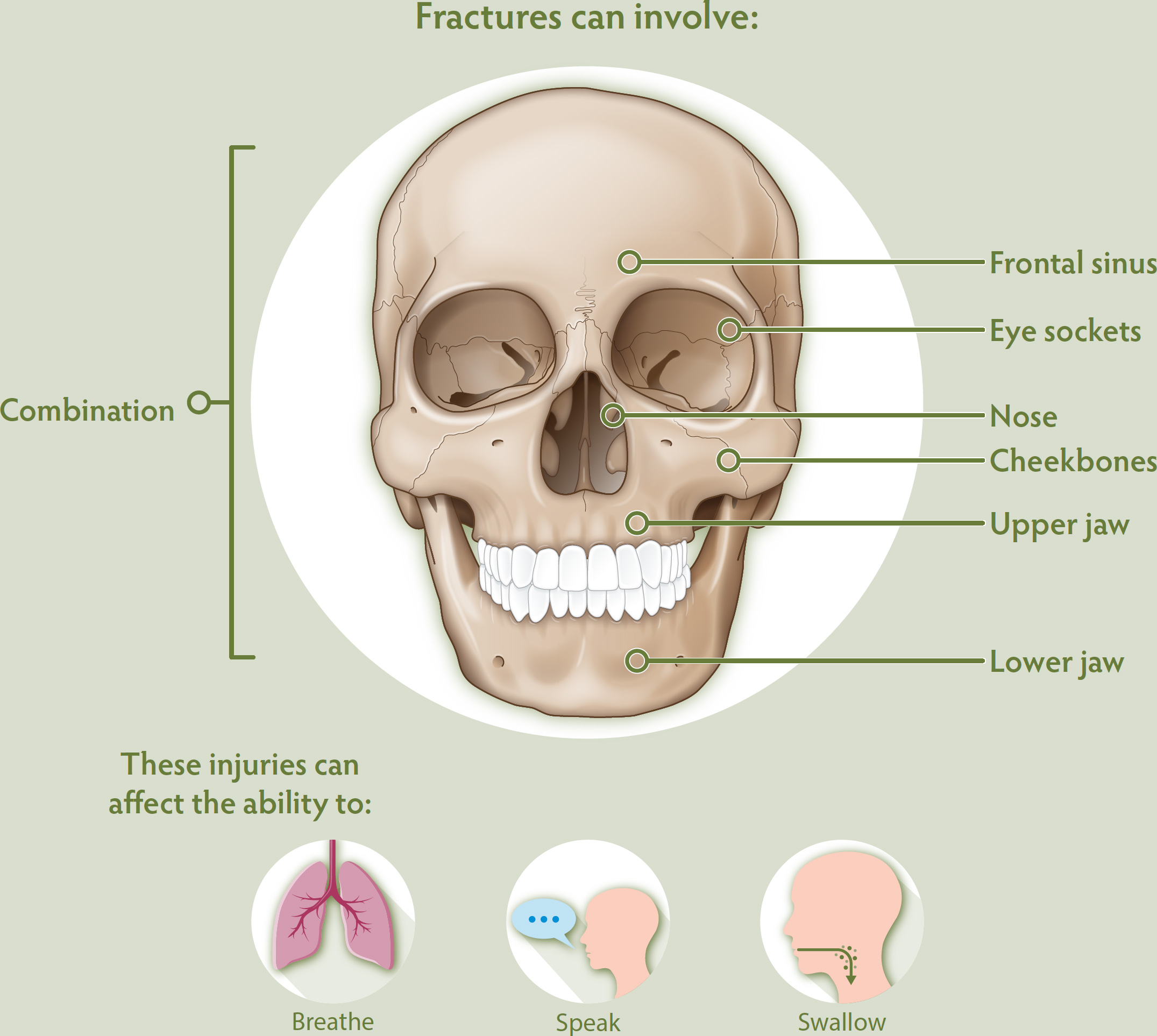 Facial fracture illustration