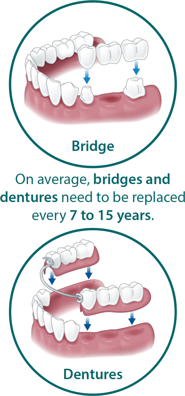bridges and dentures