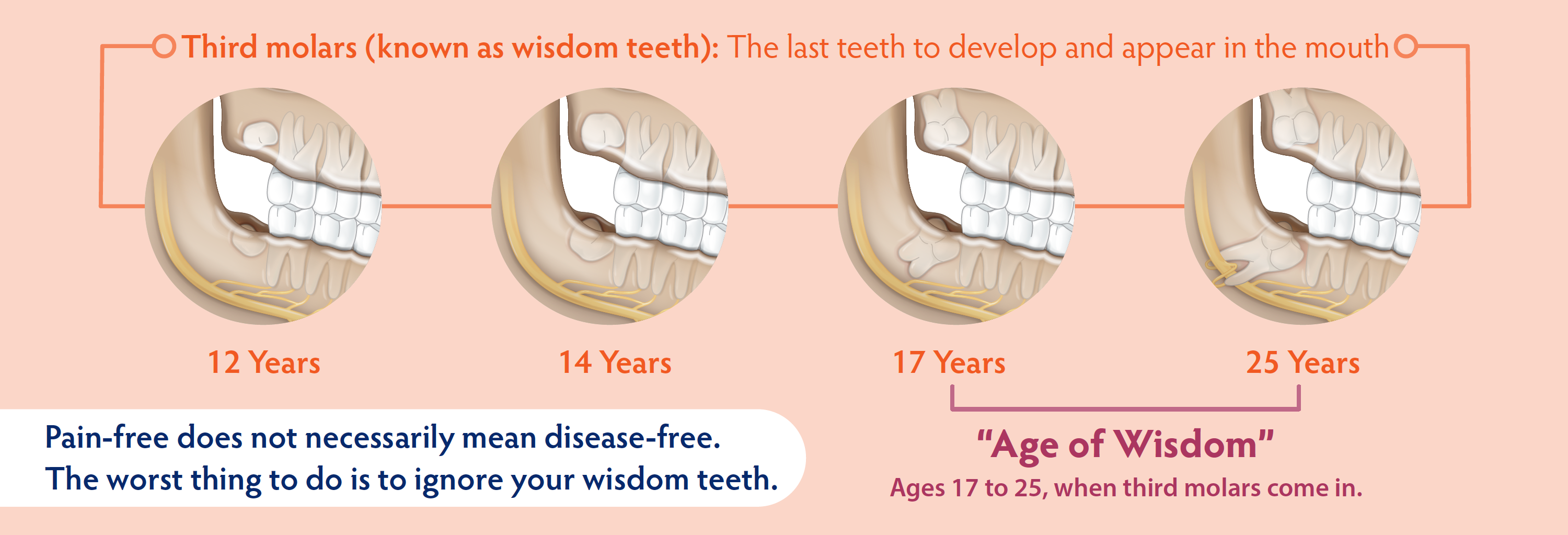 third molars progression by age