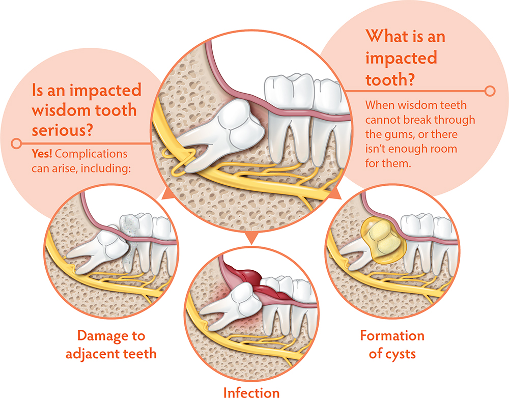 wisdom teeth illustrations